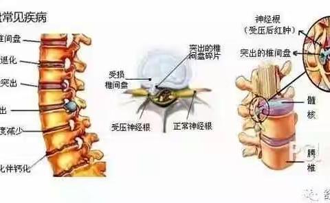 脊柱老化，可以“扶正”！