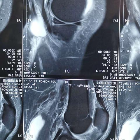 关节镜下腘窝囊肿切除