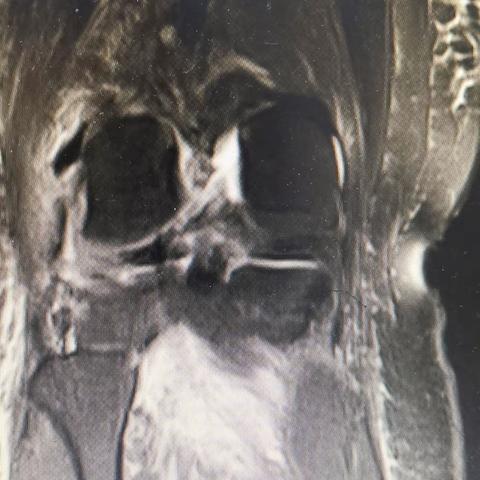 一例膝关节脱位，后交叉韧带(pcl)断裂。自体腘绳肌重建