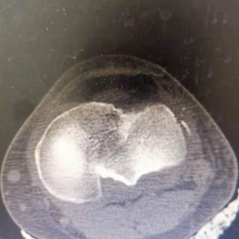 今天手术的一例segond骨折，小骨折大损伤