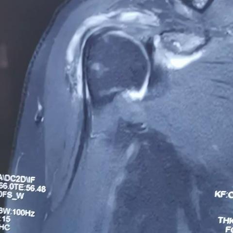 mason allen单排缝合 修复肩袖