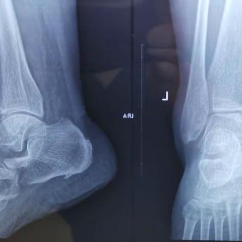 全镜下踝关节融合