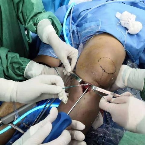 一例陈旧性前交叉韧带损伤，acl重建