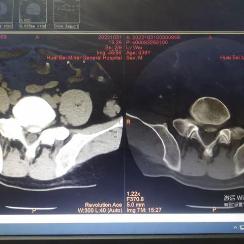 协助孟主任完成的一台UBE