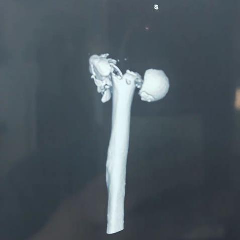 今天观摩了张院长作的一台半肩置换