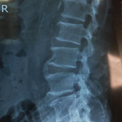 今天又观摩了我科孟主任的孔镜