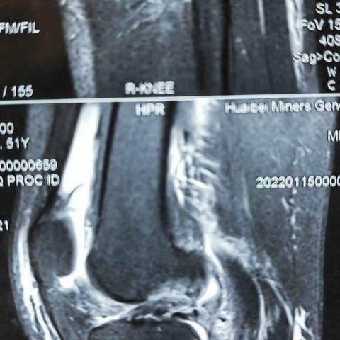 后交叉韧带重建