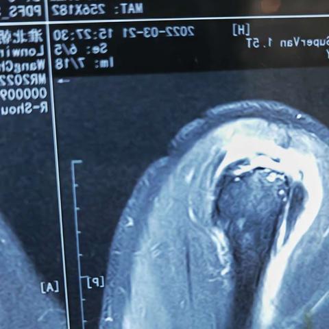 一颗锚钉解决问题