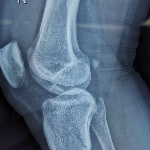 acl止点撕脱骨折镜下8字双骨道固定