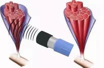沧州二医院康复院区王利春：体外冲击波在偏瘫上肢中的应用