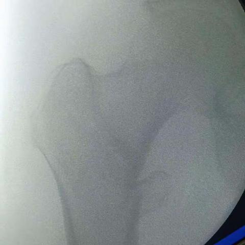 PFNA螺旋刀片的准确植入