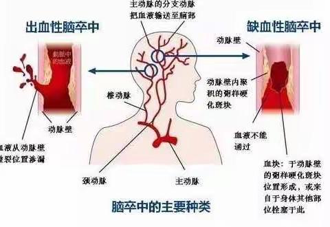 卒中预防小课堂