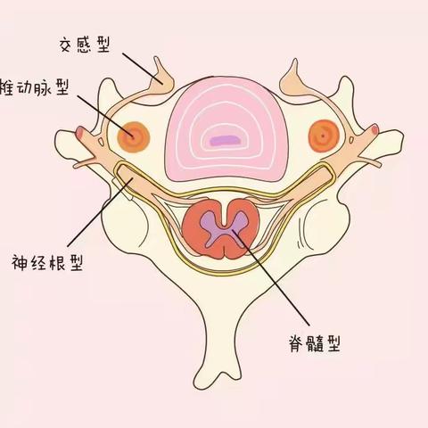 颈椎病出现这两种情况，需要尽早手术！！！