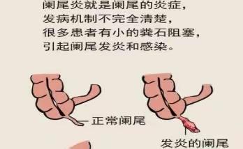 阑尾疾病健康宣教