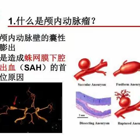 生死赛跑，拆除脑内的“不定时炸弹”——动脉瘤