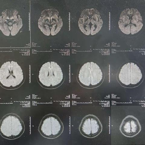 南石医院眩晕、脑病科（神经内科七病区）周围性眩晕——张荣钰医师科普（三十一）