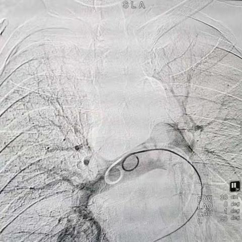 急性左下肢深静脉血栓并肺栓塞的介入治疗