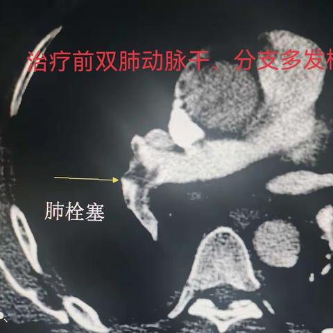 急性肺栓塞介入治疗