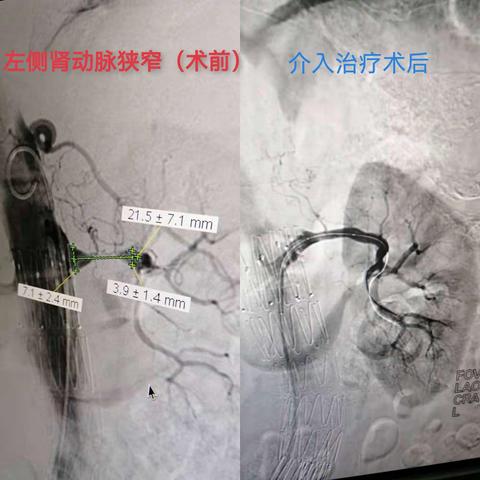 左肾动脉重度狭窄PTA+支架置入