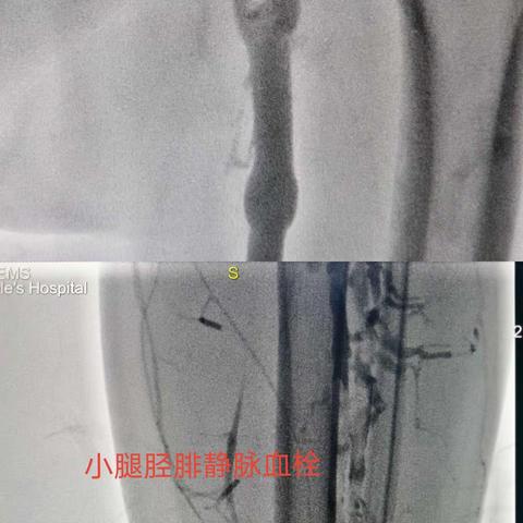 左下肢深静脉血栓的介入治疗