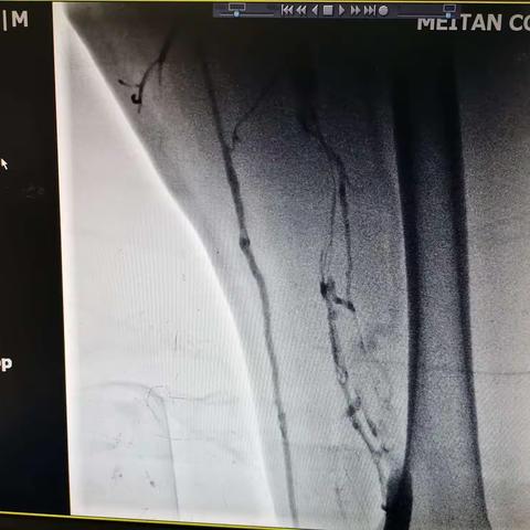 左侧股骨粗隆骨折合并下肢深静脉血栓行双下肢静脉下腔静脉造影+经右侧股静脉入路下腔静脉滤器置入