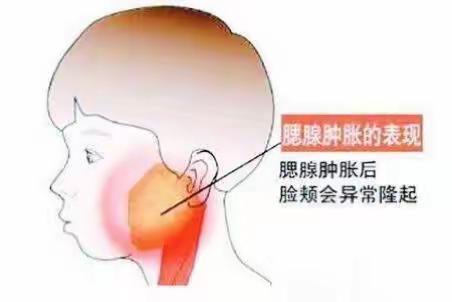 流行性腮腺炎预防知识