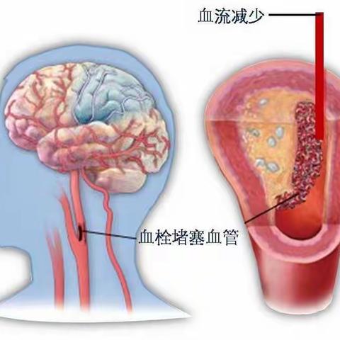 一人中风，全家发疯！卒中防治，我们一直在行动！
