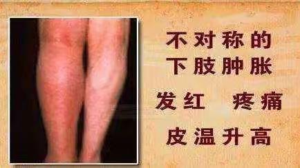得了深静脉血栓？不要慌不要跑，普外一科为您除烦恼！