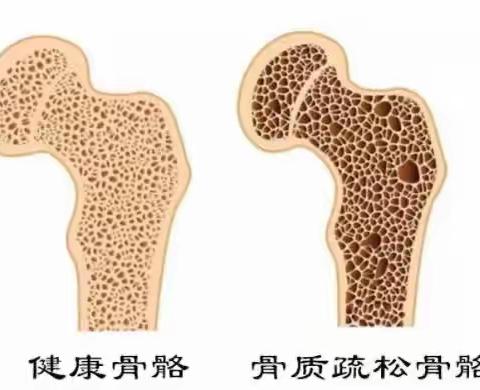 远离骨质疏松，争当“硬骨头”。