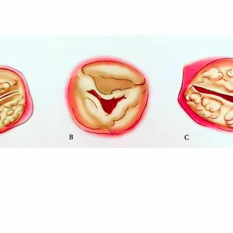 🌗 主动脉瓣狭窄