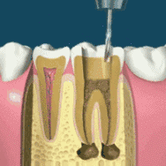 卓维雅口腔早报分享“ 为什么根管治疗做好还要做冠？  牙齿劈裂怎么办？  ”