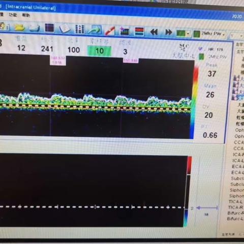 TCD高度怀疑LMCA闭塞一例