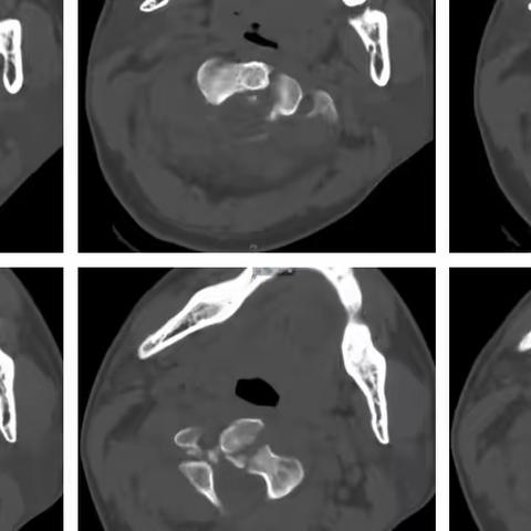 望而生畏又妙笔生花：枢椎椎体骨折病例报道及浅析