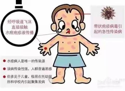 如何预防水痘