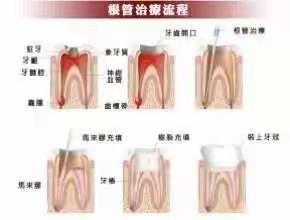 牙齿根管治疗后为什么要做牙冠？