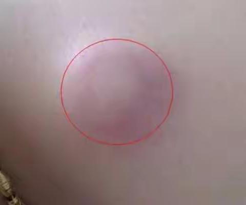 什么是皮脂腺囊肿