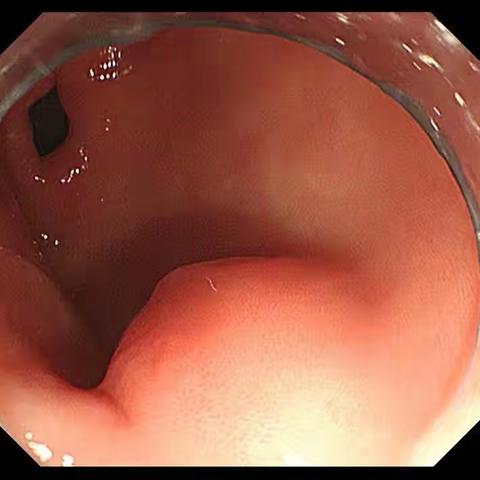 “镜心镜力 护胃肠健康”—师宗仁和医院消化内镜诊疗技术获新突破