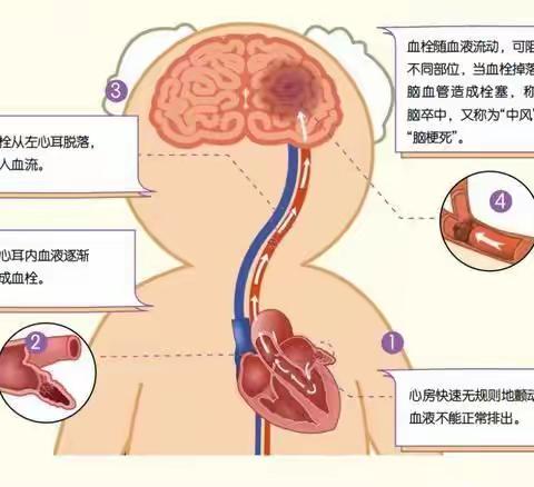 岳阳首例!左心耳封堵术:房颤患者预防卒中新武器！