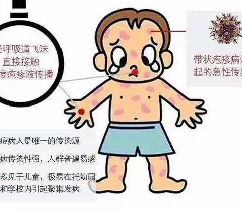 认识水痘，预防水痘！——糜杆桥镇中心幼儿园传染病预防宣传（二）