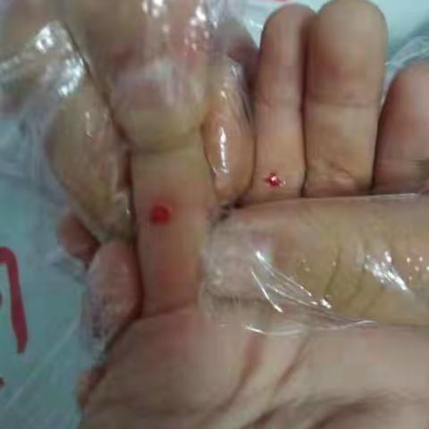 中医篇～～针刺四缝穴