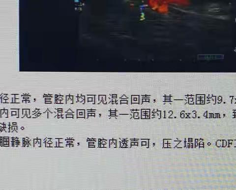 介入无置入，从容做手术—-一例股浅动脉闭塞的介入治疗