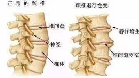 骨质增生病例分享