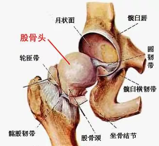 无菌性股骨头坏死治疗案例分享