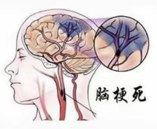 运动神经元病的症状，是否有着急？看看这个！