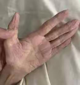 西医和中医到底哪个能治疗渐冻症
