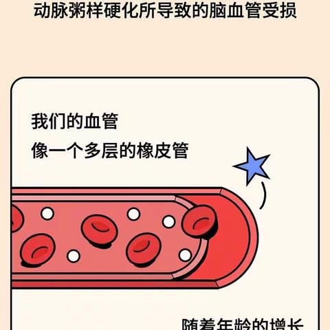 康养帮——杭州康复平台提醒您中风预防非常重要