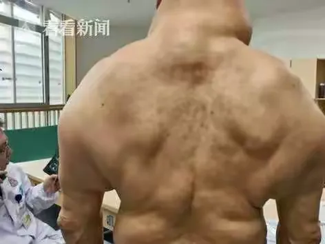 马德龙病又叫多发性对称性脂肪增多症，是一种罕见病，多发于中年男性。可以导致酒精在肝脏中的代谢出现紊乱