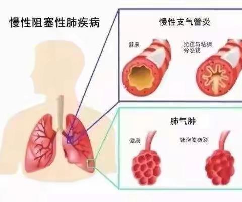 慢性阻塞性肺疾病…科普知识