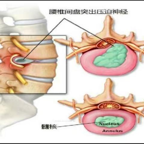 腰椎间盘突出……