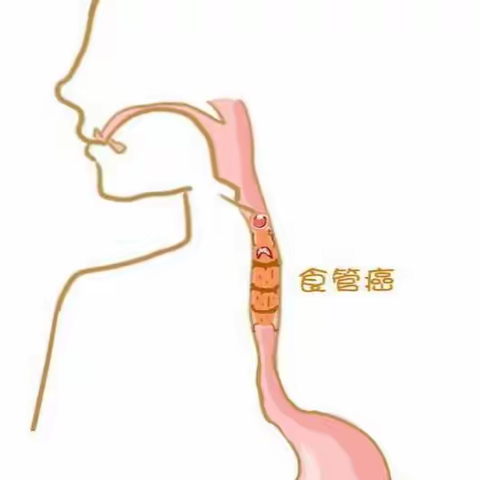 如果您吃东西出现吞咽困难，有可能是食管癌？